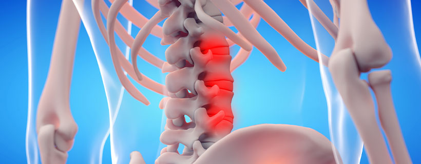 patient needing Ankylosing Spondylitis chiropractor in Addison TX