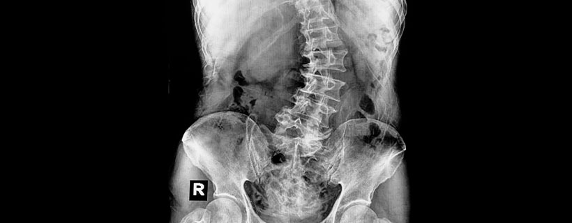 patient needing scoliosis chiropractor in Addison TX